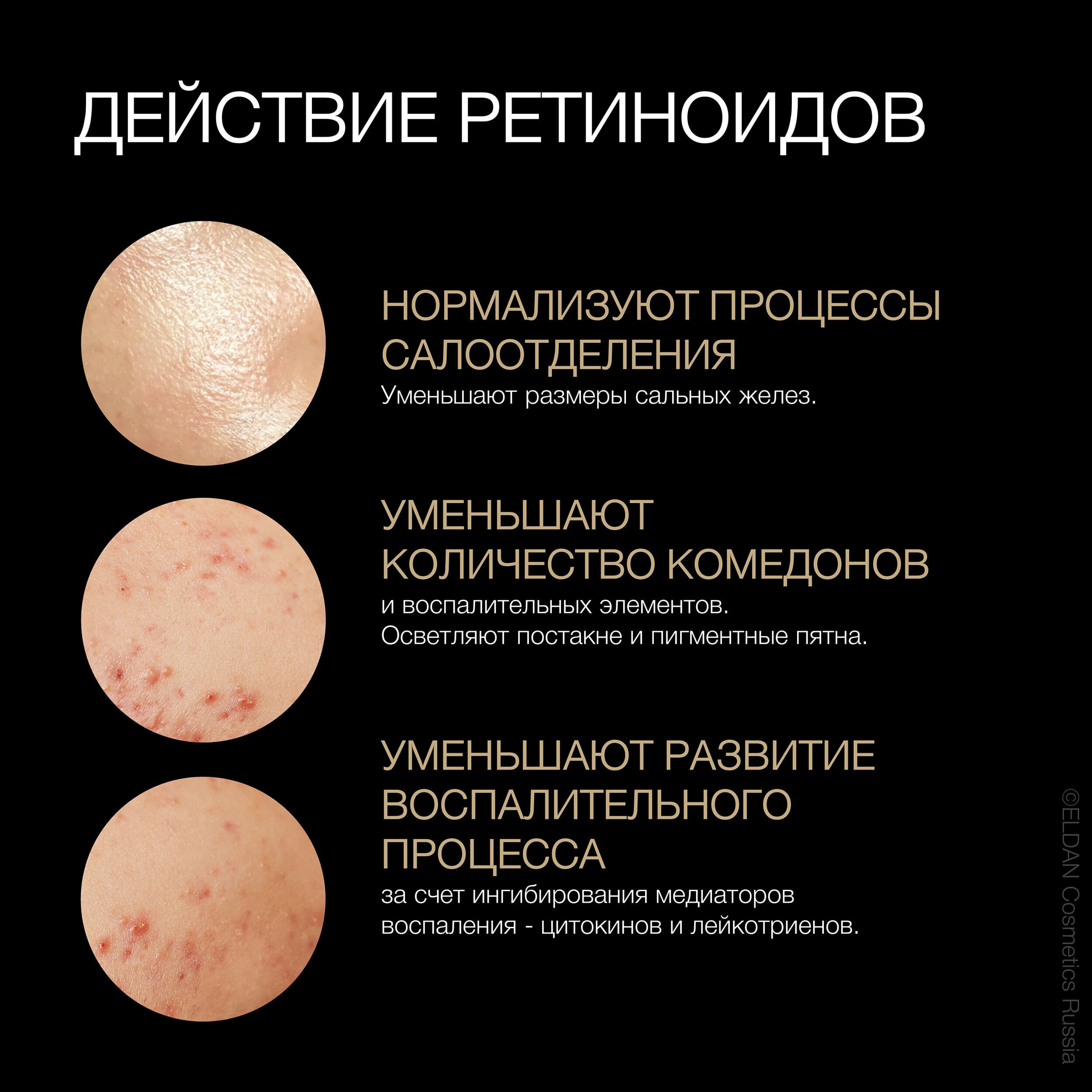 Ретинол против акне — Лечение угревой болезни с помощью ретиноидов ELDAN  Cosmetics
