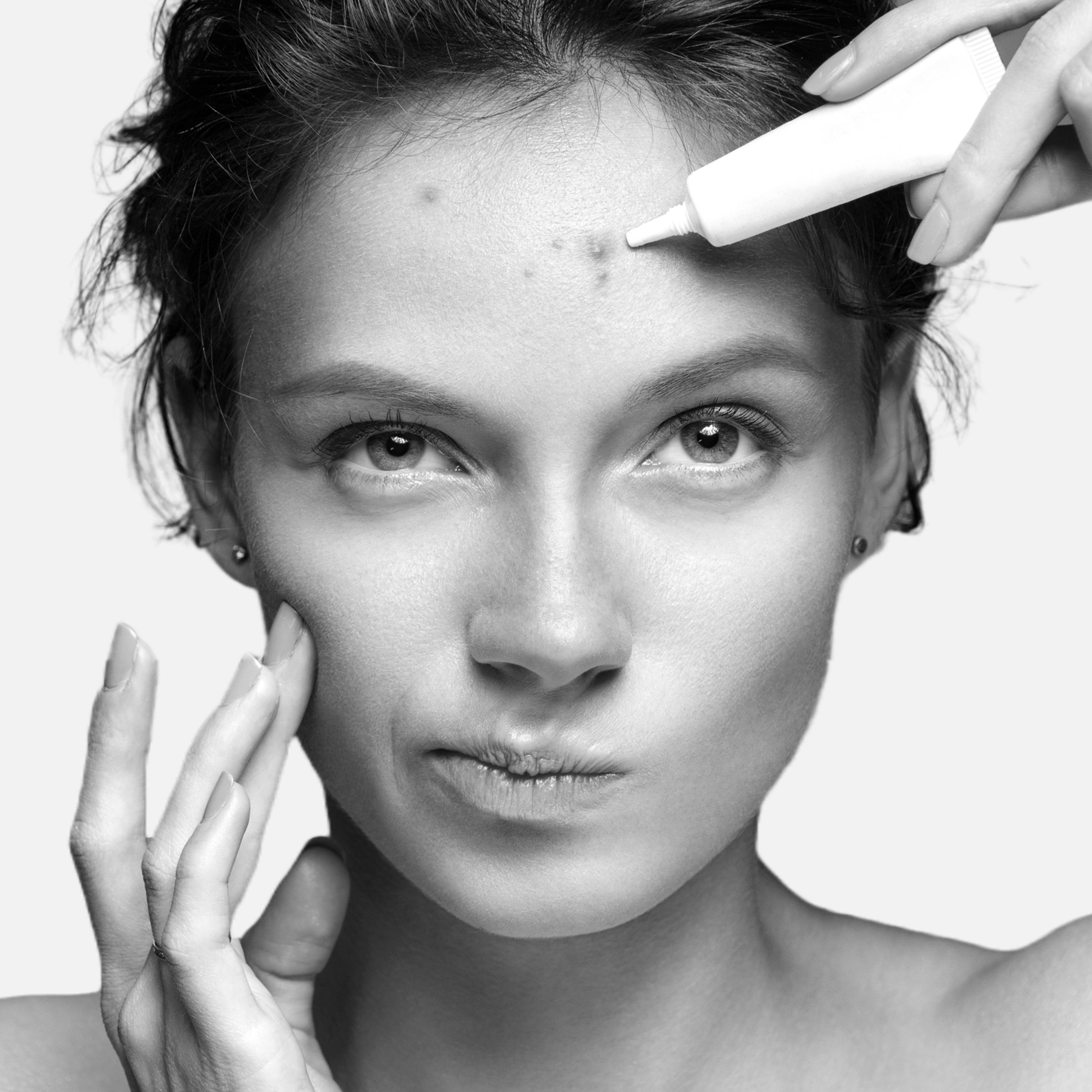 Пять фактов про акне