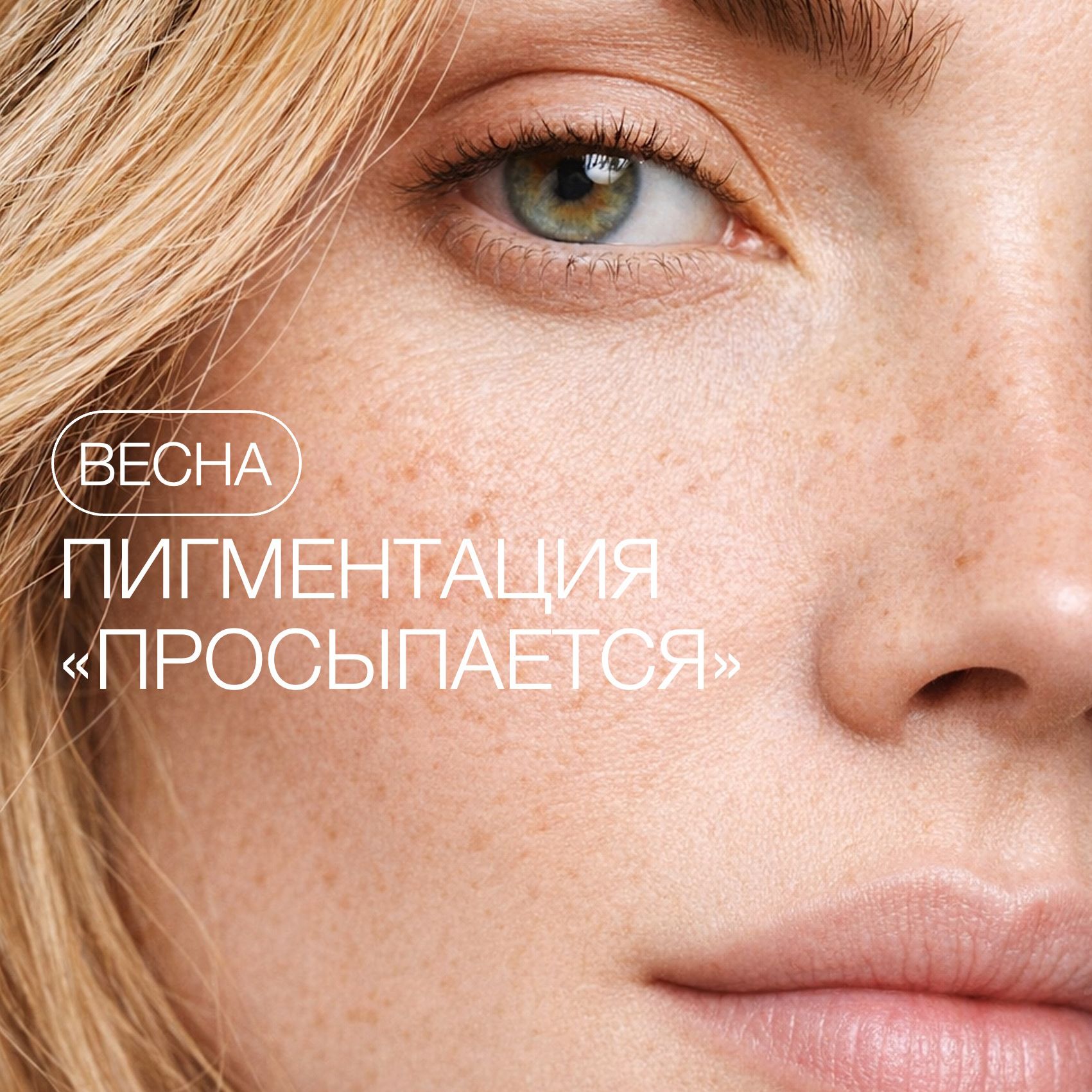 ПОЧЕМУ ПИГМЕНТАЦИЯ "ПРОСЫПАЕТСЯ" ВЕСНОЙ?