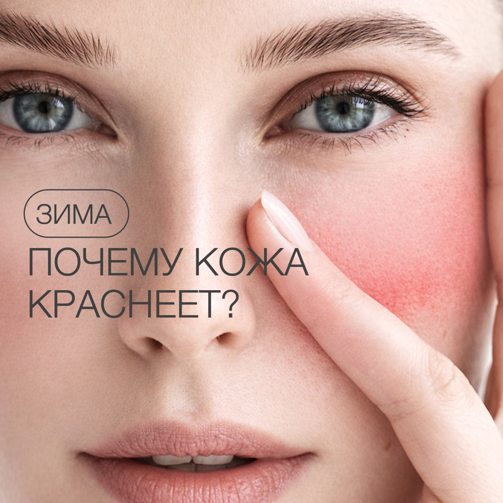 ЗИМНЯЯ КРАСНОТА КОЖИ: ПОЧЕМУ ЛИЦО КРАСНЕЕТ