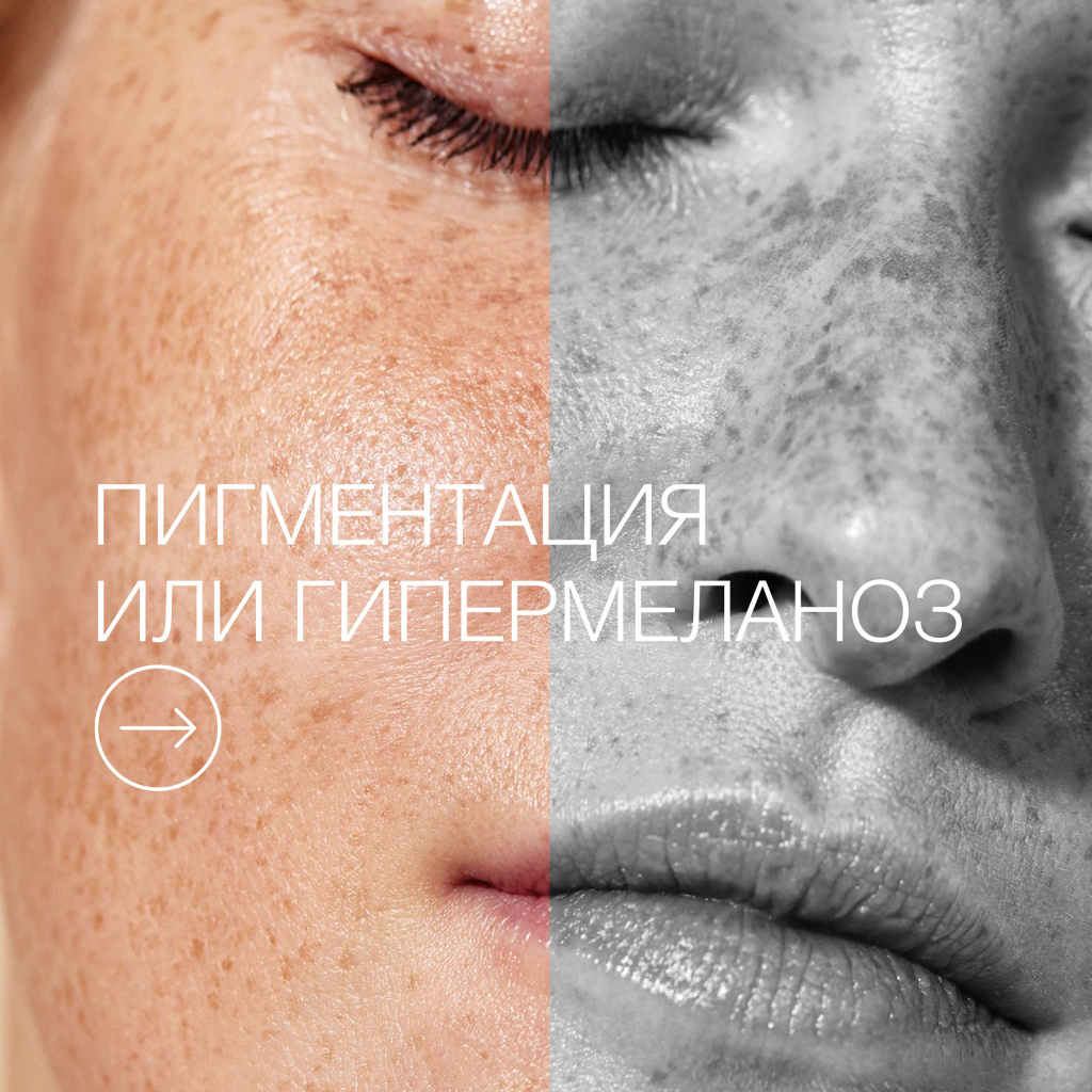 Пост пигментация 2.jpg