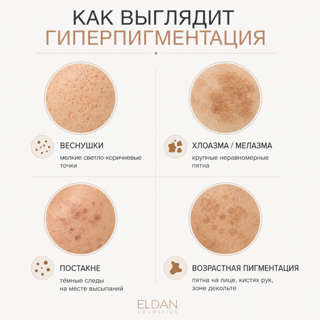 Как выглядит гиперпигментация