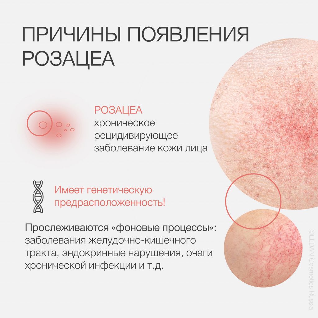 Пост розацеа 2.jpg Пост розацеа 2.jpg