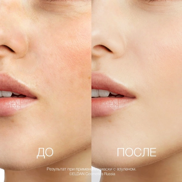 Маска с Азуленом До-после сайт