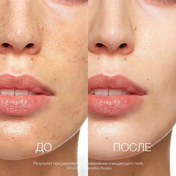 Очищающий гель 03 До-после сайт