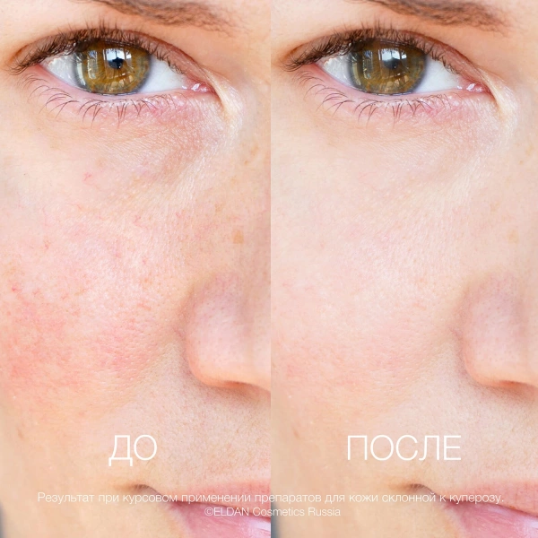 ELD-10 Крем для кожи склонной к куперозу_4