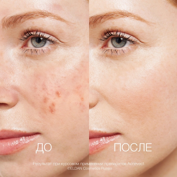 ELD_S-131 Очищающий тоник-лосьон для проблемной кожи_3