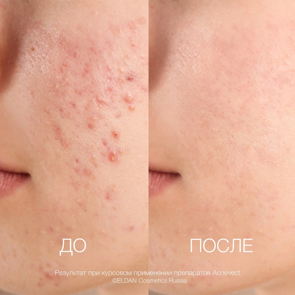 ELD_S-131 Очищающий тоник-лосьон для проблемной кожи_4